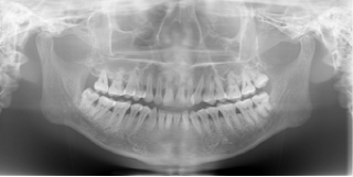 パノラマレントゲン