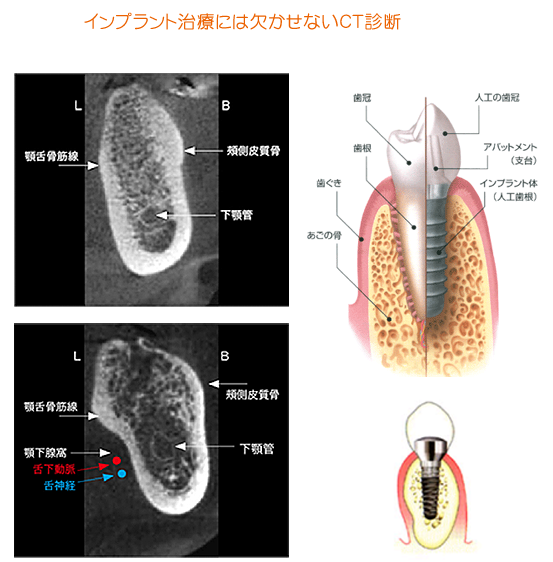 インプラント治療に欠かせないCT診断